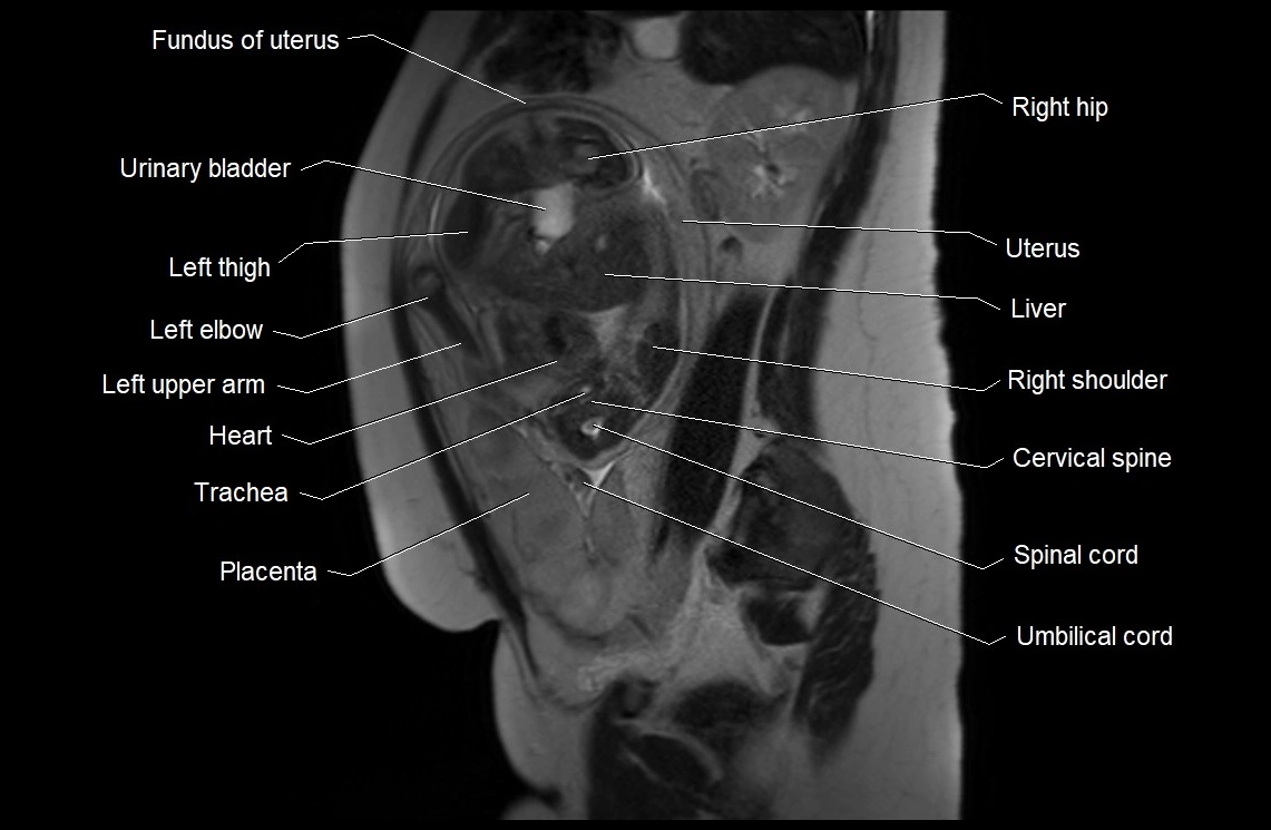 MRI fetal anatomy sagittal image 12.webp